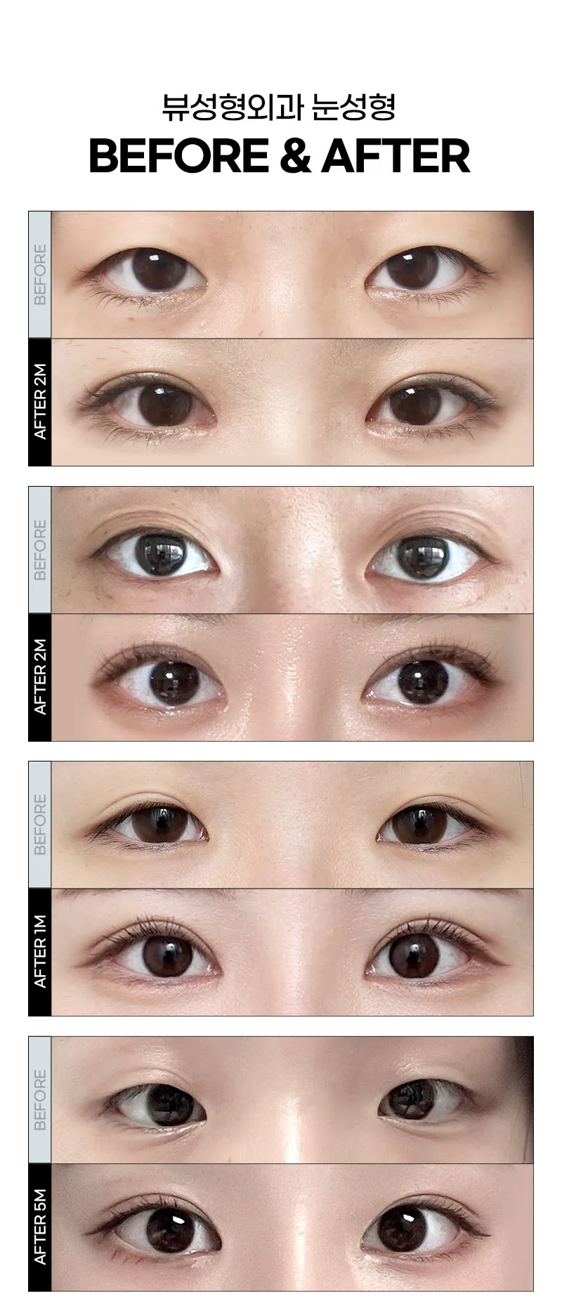 뷰성형외과 ❤️뷰❤️눈성형 이벤트, 시술 상세 이미지