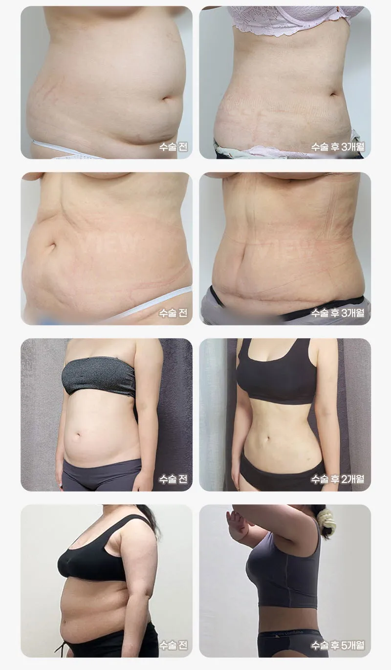 뷰성형외과 ❤️뷰❤️대용량 지방흡입 이벤트, 시술 상세 이미지