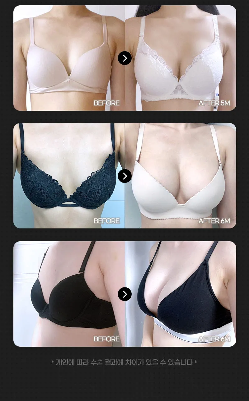 뷰성형외과 ❤️뷰❤️UIU 가슴성형 240 이벤트, 시술 상세 이미지