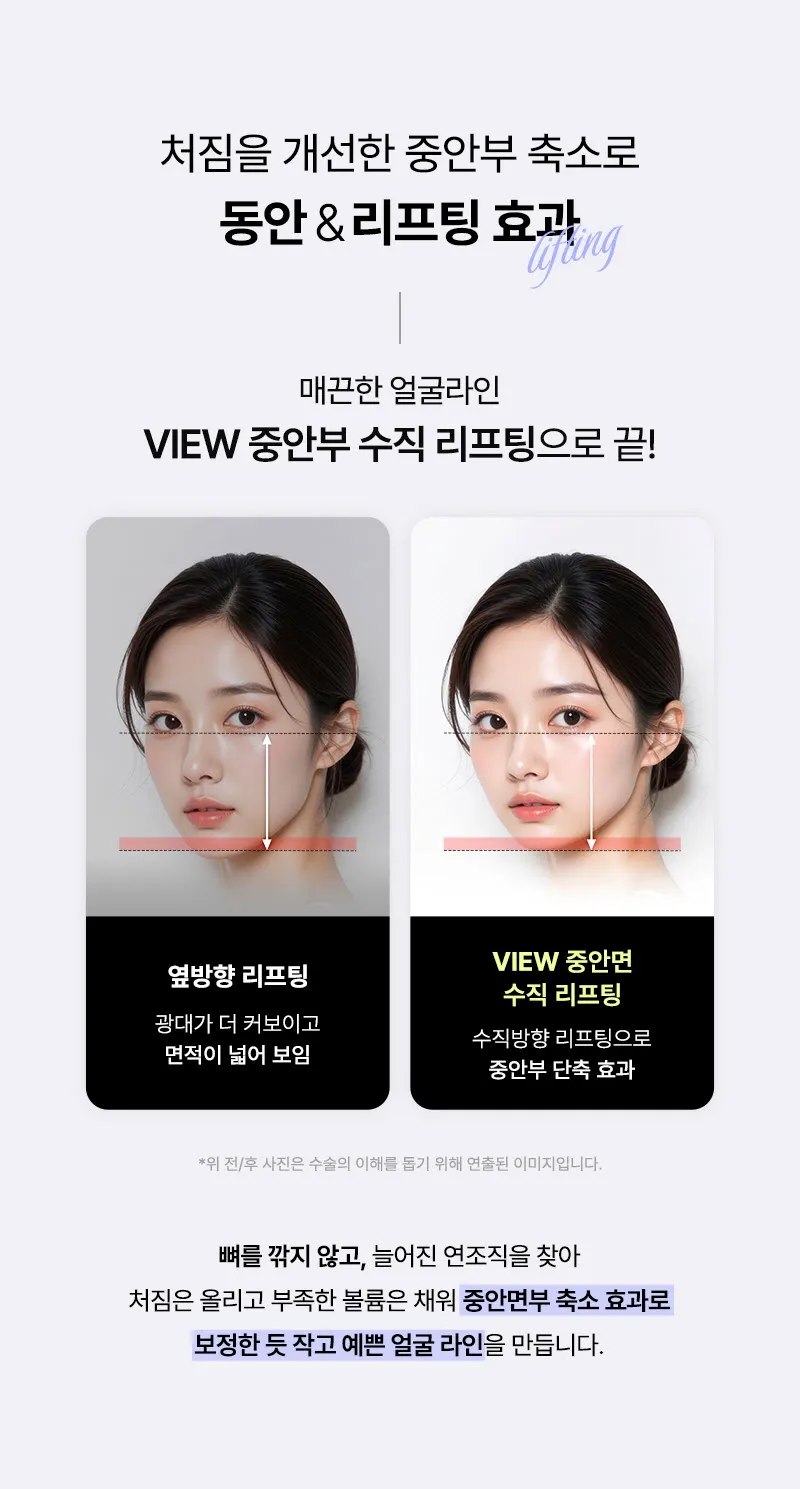 뷰성형외과 ❤뷰❤중안면 수직 리프팅 이벤트, 시술 상세 이미지