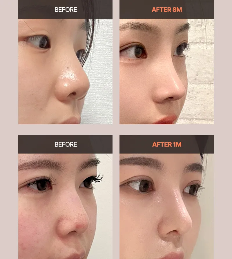 뷰성형외과 ❤️뷰❤️기능코성형 이벤트, 시술 상세 이미지