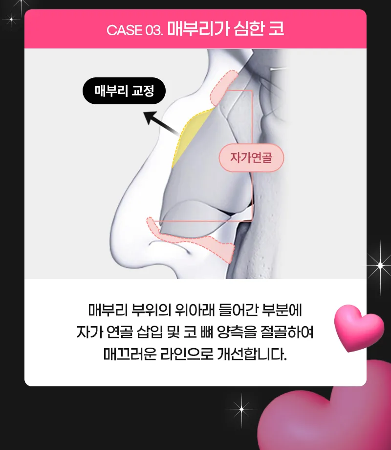 뷰성형외과 ❤️뷰❤️매부리코성형 이벤트, 시술 상세 이미지