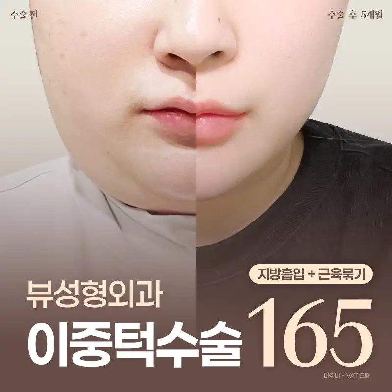 ❤뷰❤얼굴 지방흡입