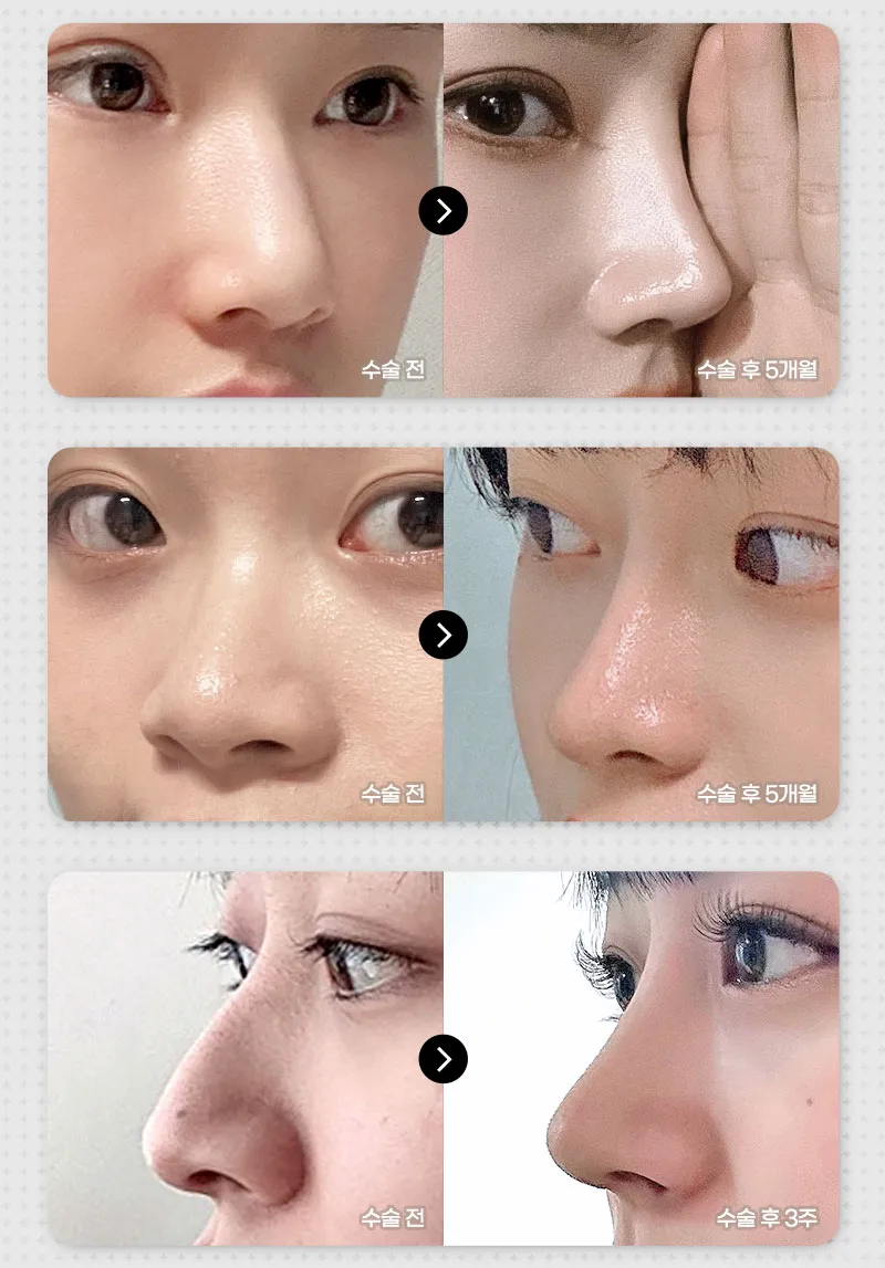 뷰성형외과 ❤️뷰❤️코재수술 이벤트, 시술 상세 이미지
