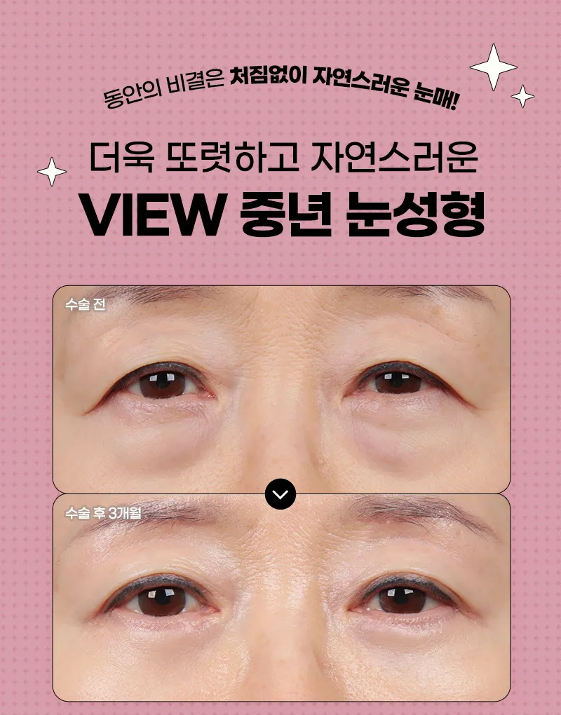 뷰성형외과 ❤️뷰❤️중년 눈성형 이벤트, 시술 상세 이미지