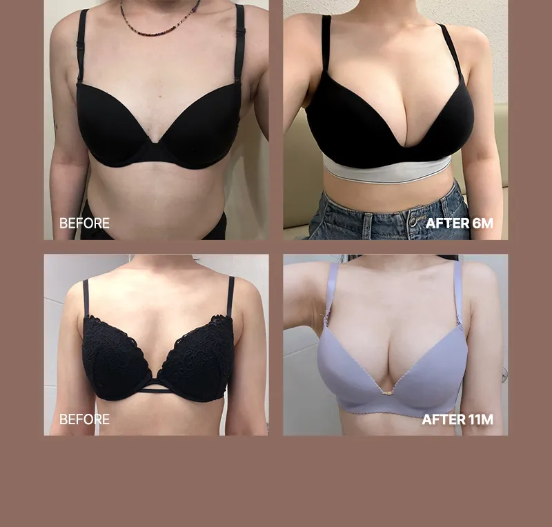 뷰성형외과 ❤뷰❤여의사 UIU 가슴성형 이벤트, 시술 상세 이미지