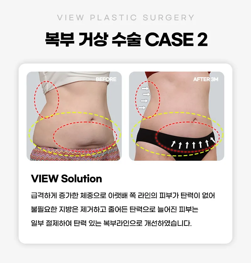 뷰성형외과 ❤뷰❤복부거상술 이벤트, 시술 상세 이미지