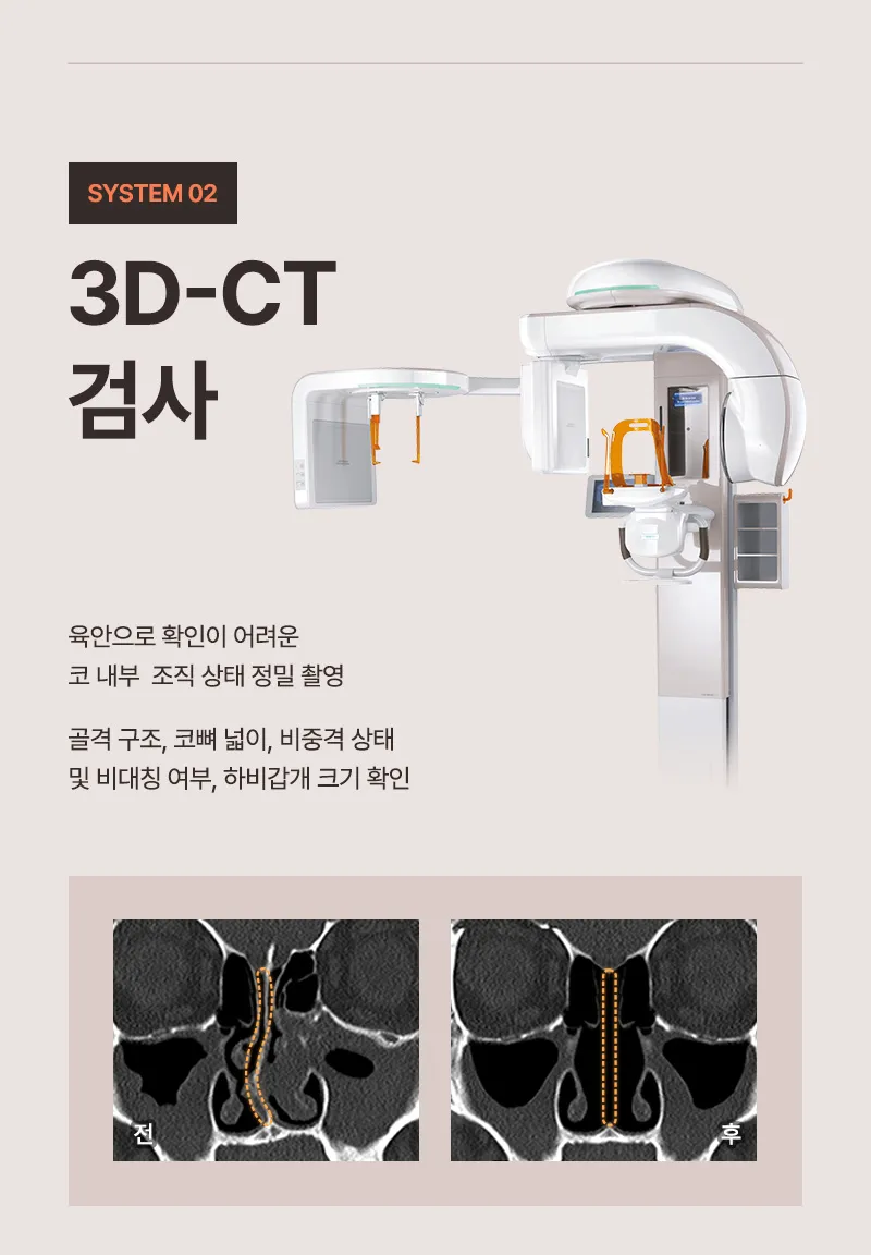 뷰성형외과 ❤️뷰❤️기능코성형 이벤트, 시술 상세 이미지