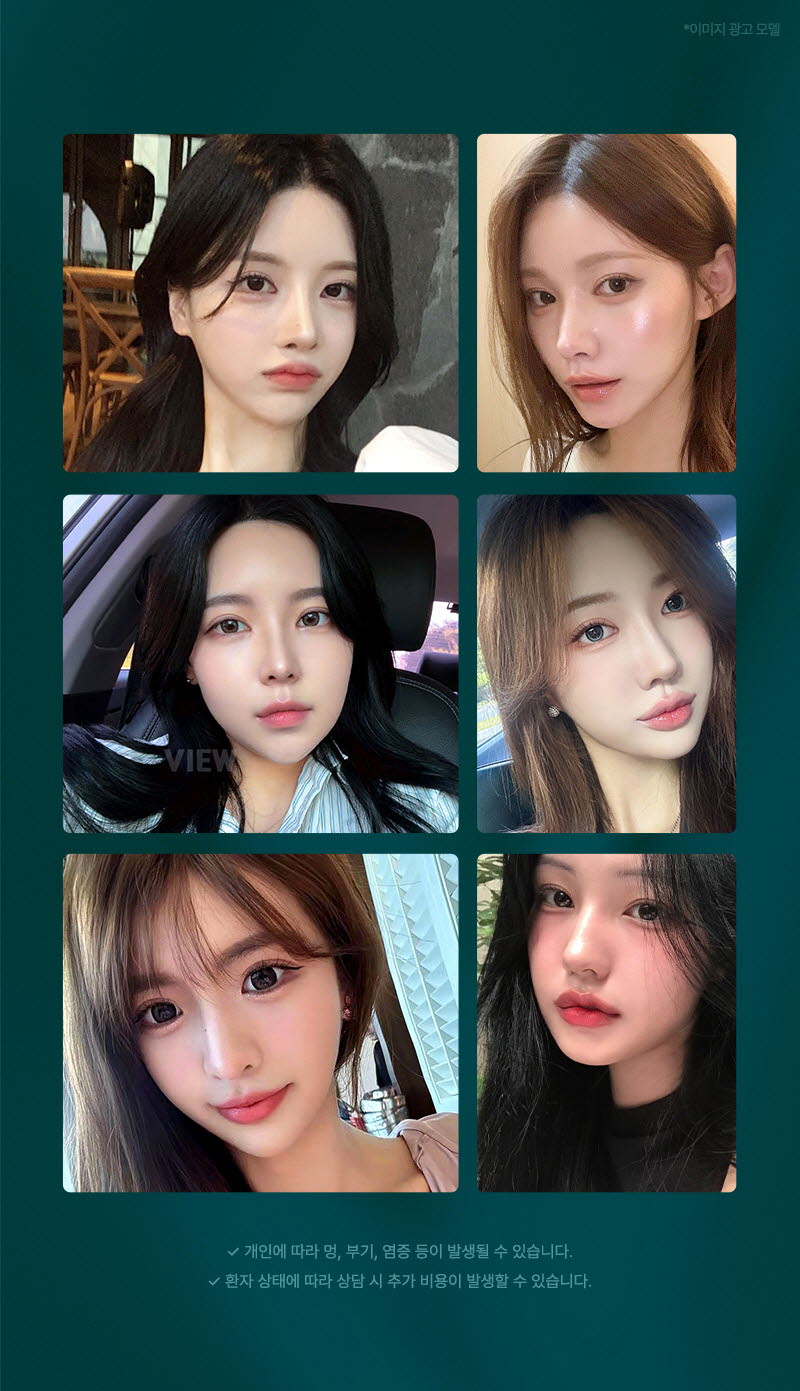 뷰성형외과 ❤뷰❤온다리프팅 이벤트, 시술 상세 이미지