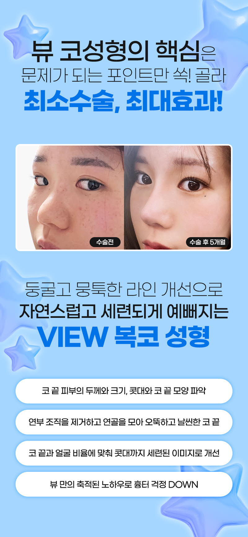 뷰성형외과 ❤️뷰❤️복코성형 이벤트, 시술 상세 이미지