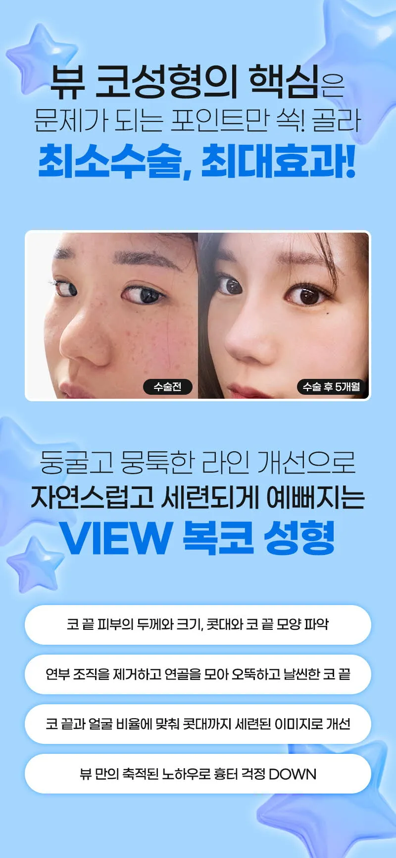 뷰성형외과 ❤️뷰❤️복코성형 이벤트, 시술 상세 이미지