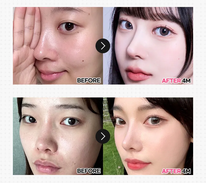 뷰성형외과 ❤️뷰❤️매부리코성형 이벤트, 시술 상세 이미지