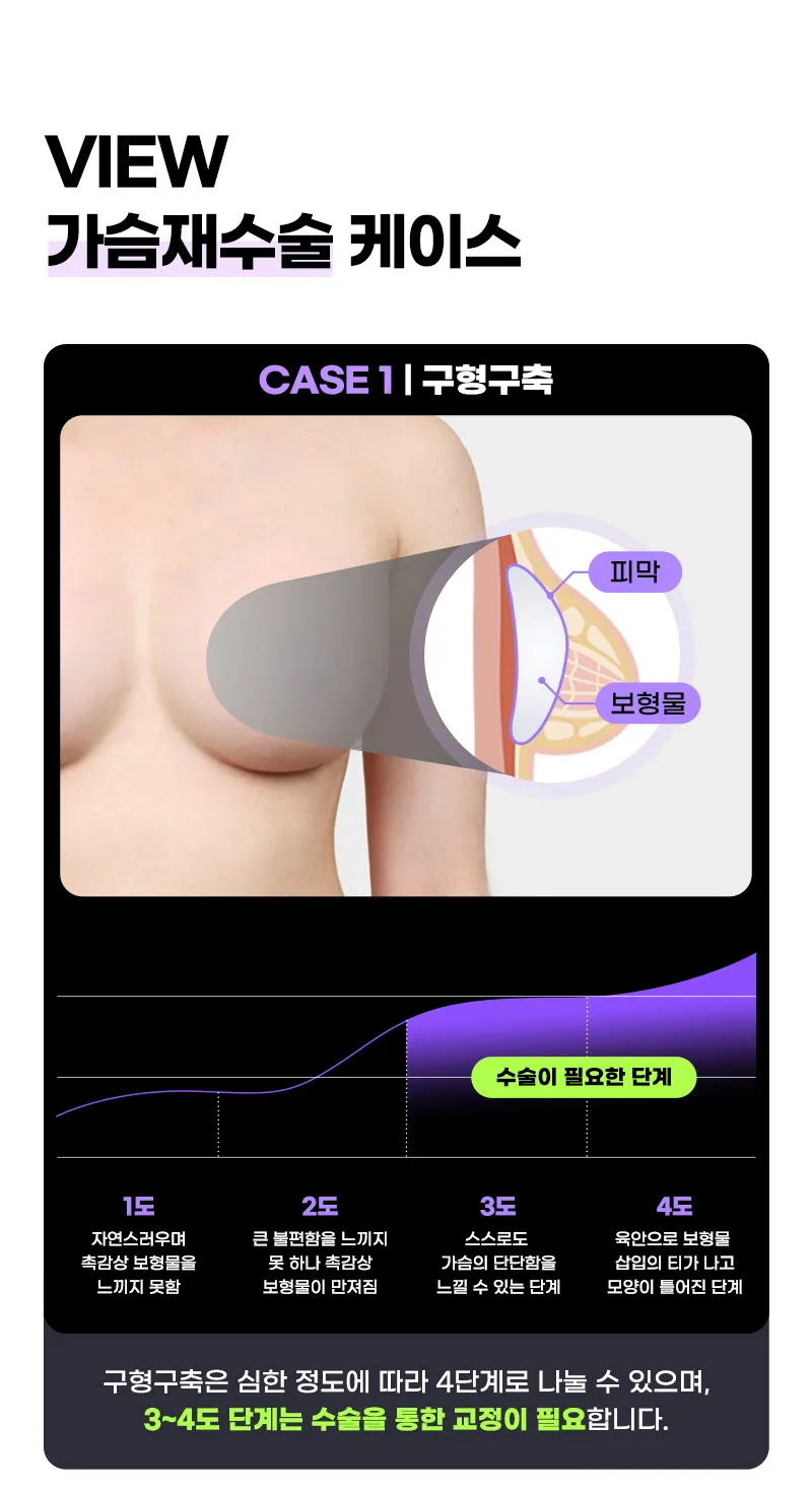 뷰성형외과 ❤뷰❤모티바 가슴 재수술 이벤트, 시술 상세 이미지