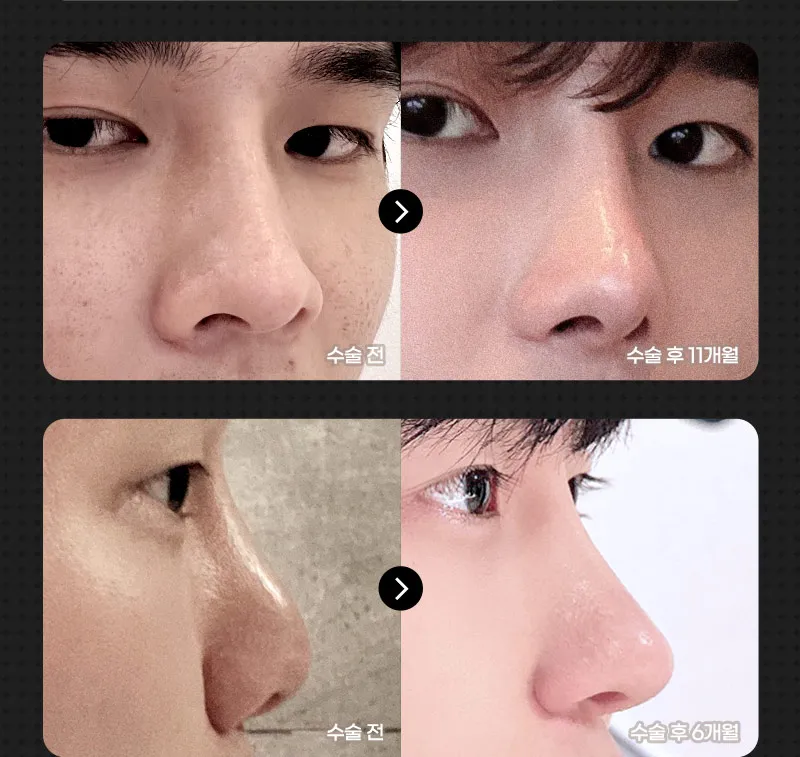 ❤️뷰❤️코성형
