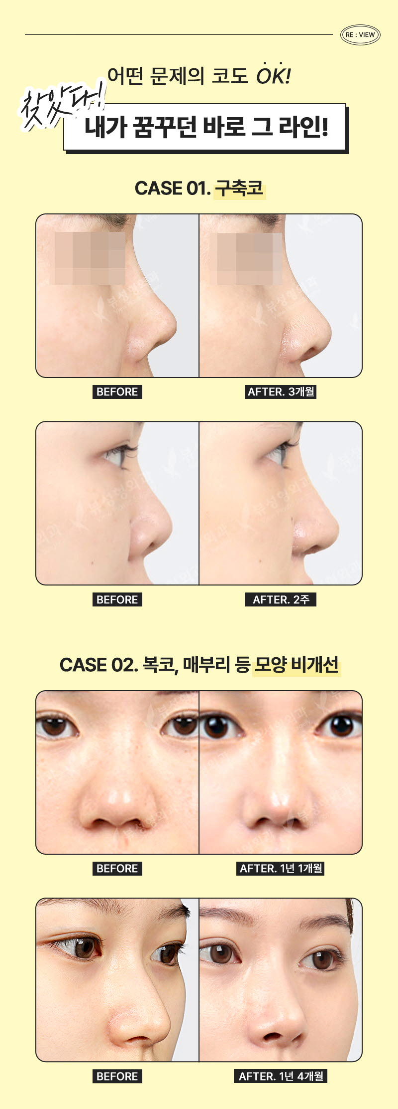 뷰성형외과 ❤️뷰❤️코재수술 이벤트, 시술 상세 이미지