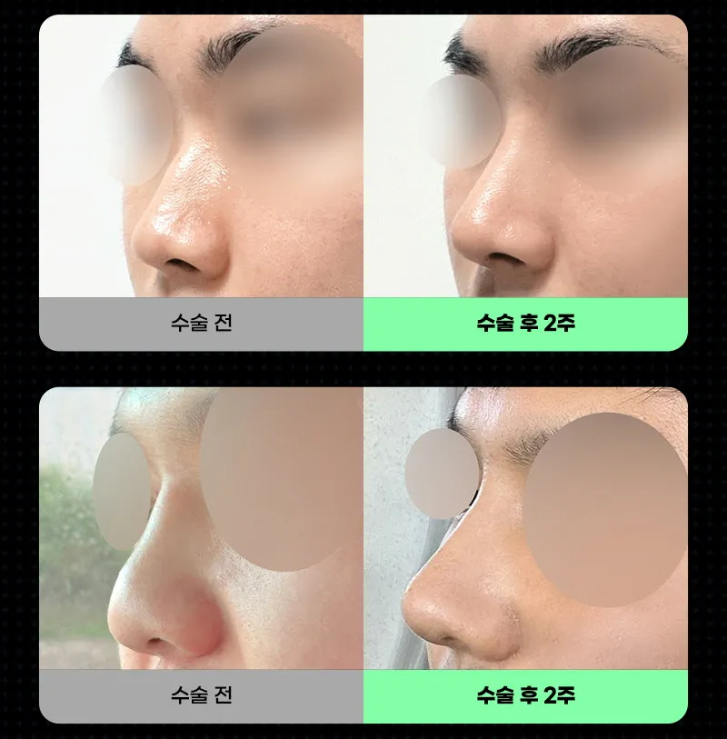 뷰성형외과 ❤️뷰❤️남자코성형 이벤트, 시술 상세 이미지