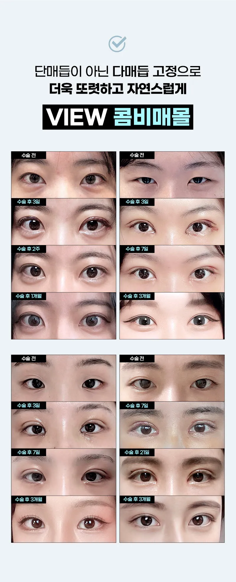 뷰성형외과 ❤️뷰❤️눈성형 이벤트, 시술 상세 이미지