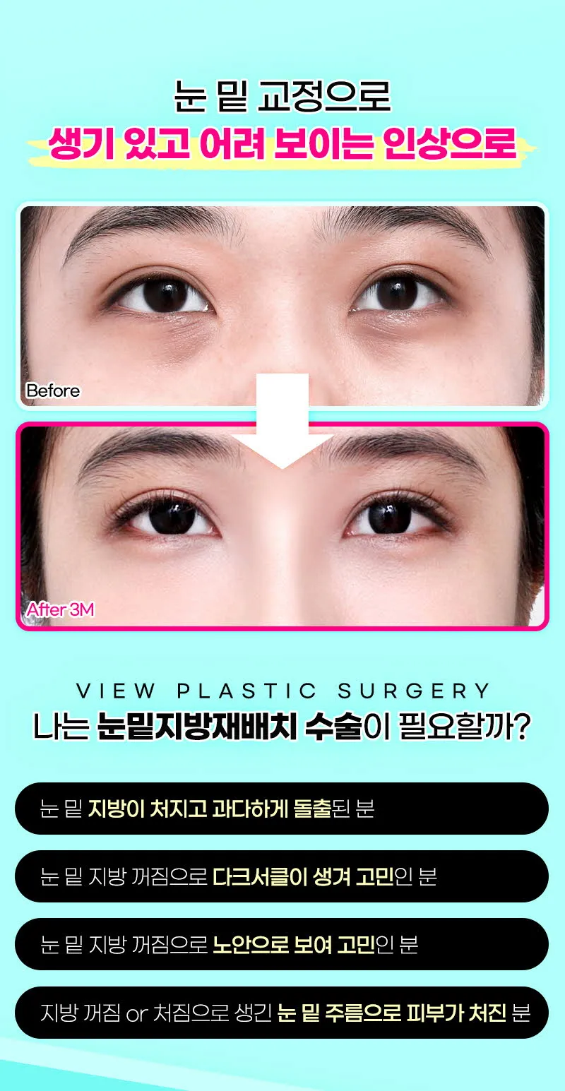 뷰성형외과 ❤️뷰❤️눈밑지방재배치 이벤트, 시술 상세 이미지