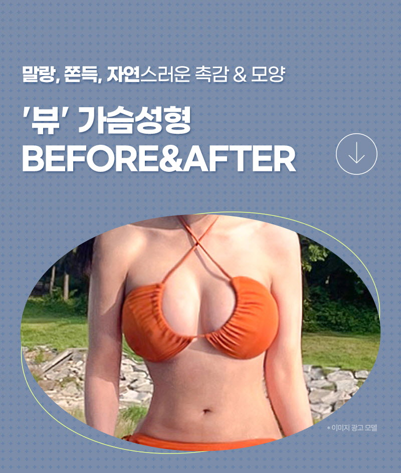 뷰성형외과 ❤️뷰❤️UIU 멘토 엑스트라 이벤트, 시술 상세 이미지