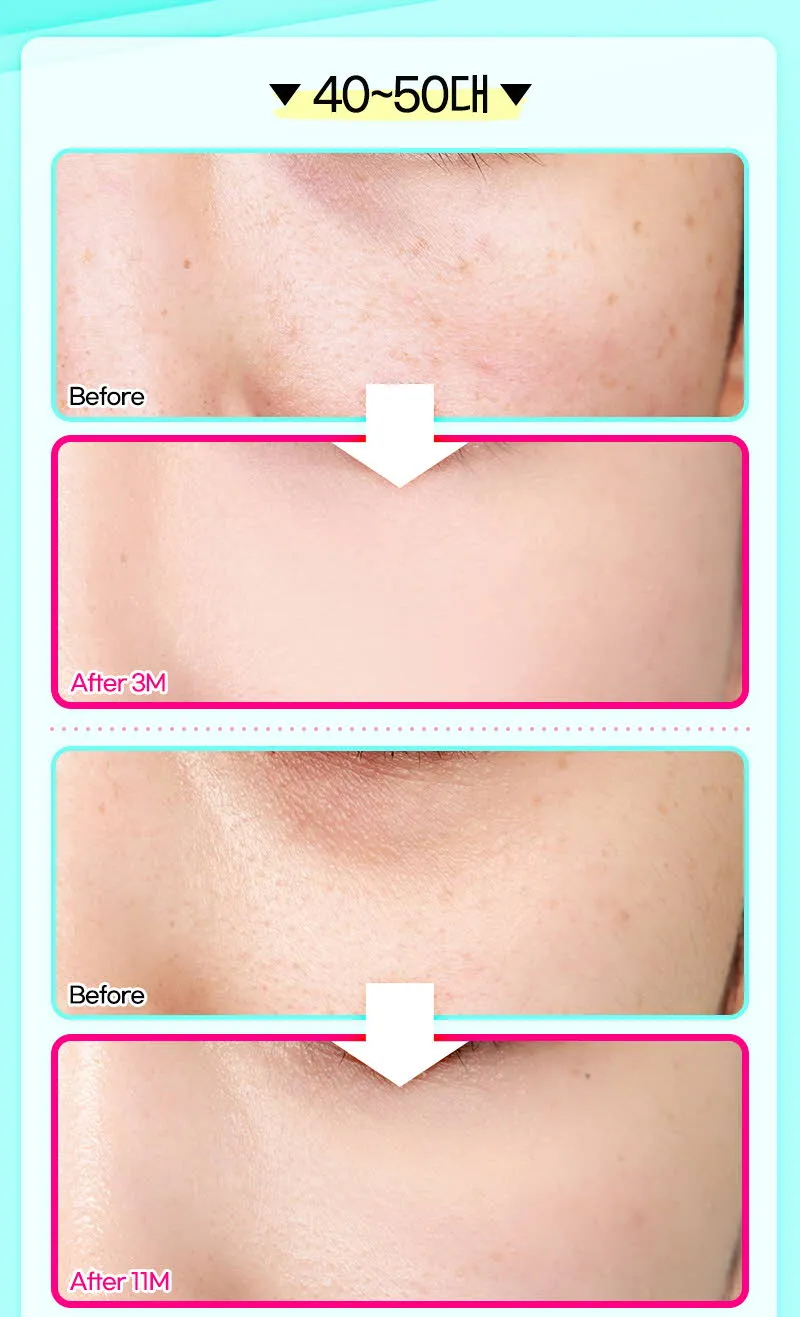 뷰성형외과 ❤️뷰❤️눈밑지방재배치 이벤트, 시술 상세 이미지