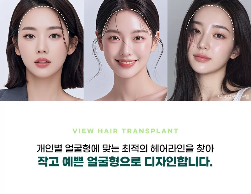 뷰성형외과 ❤뷰❤헤어라인 모발이식 이벤트, 시술 상세 이미지