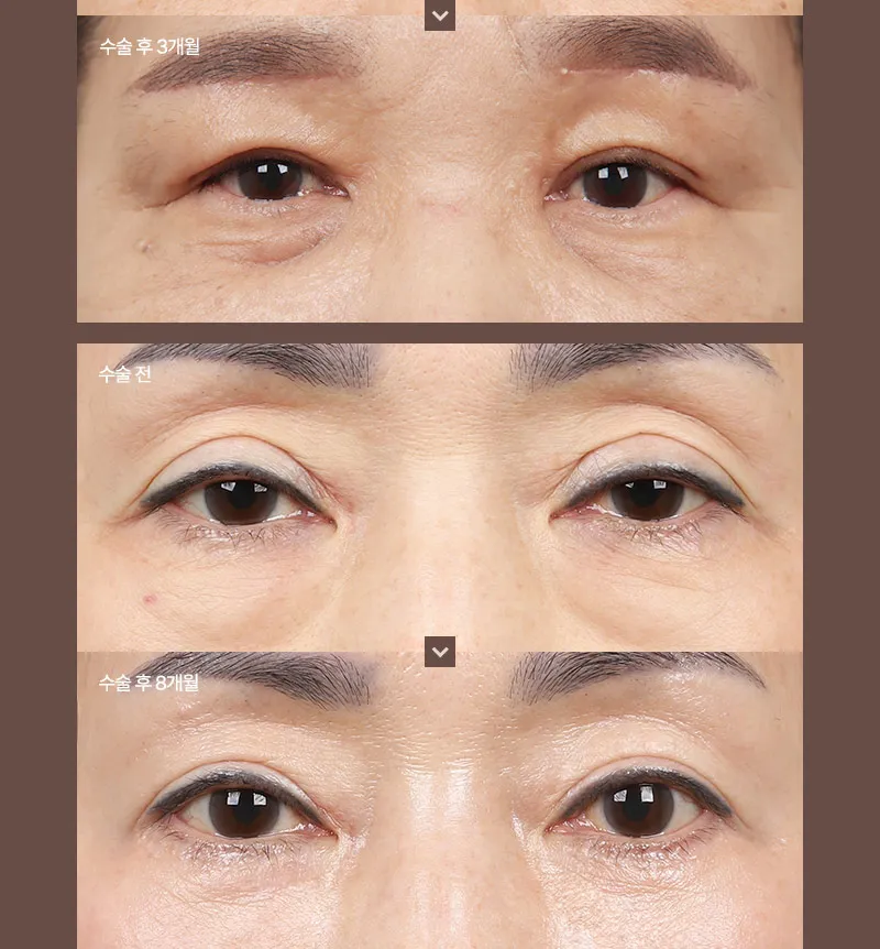 ❤️뷰❤️중년 눈성형