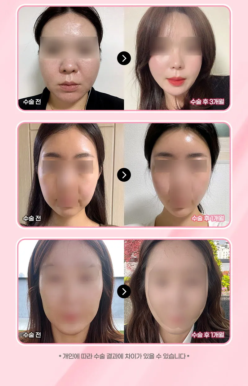 뷰성형외과 ❤뷰❤써마지 FLX 리프팅 이벤트, 시술 상세 이미지