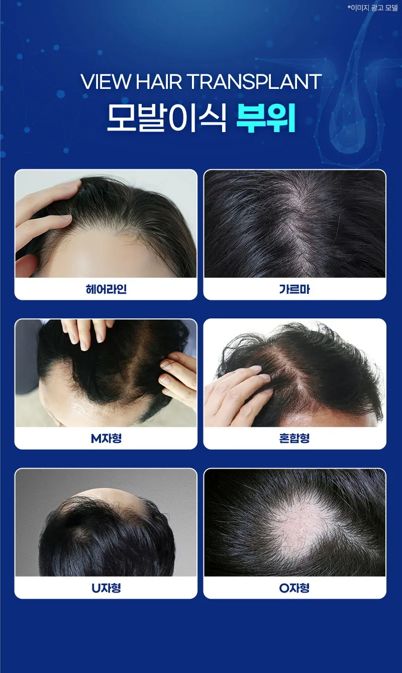뷰성형외과 ❤뷰❤모발이식 이벤트, 시술 상세 이미지