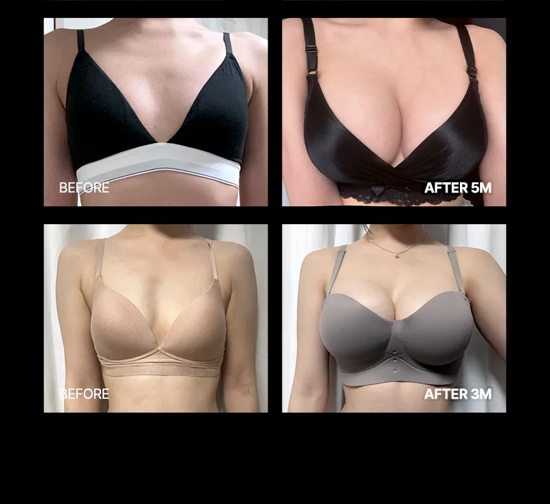 뷰성형외과 ❤뷰❤여의사 UIU 가슴성형 이벤트, 시술 상세 이미지
