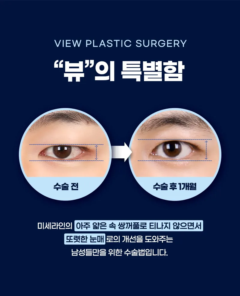 뷰성형외과 ❤️뷰❤️남자 눈성형 이벤트, 시술 상세 이미지