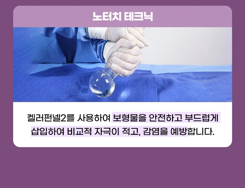 뷰성형외과 ❤️뷰❤️ 모티바 가슴성형 이벤트, 시술 상세 이미지