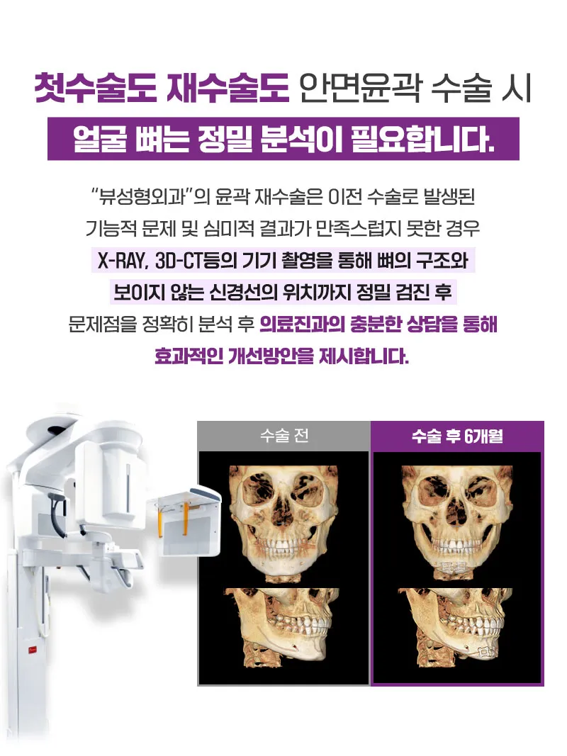 뷰성형외과 ❤️뷰❤️안면윤곽 재수술 이벤트, 시술 상세 이미지