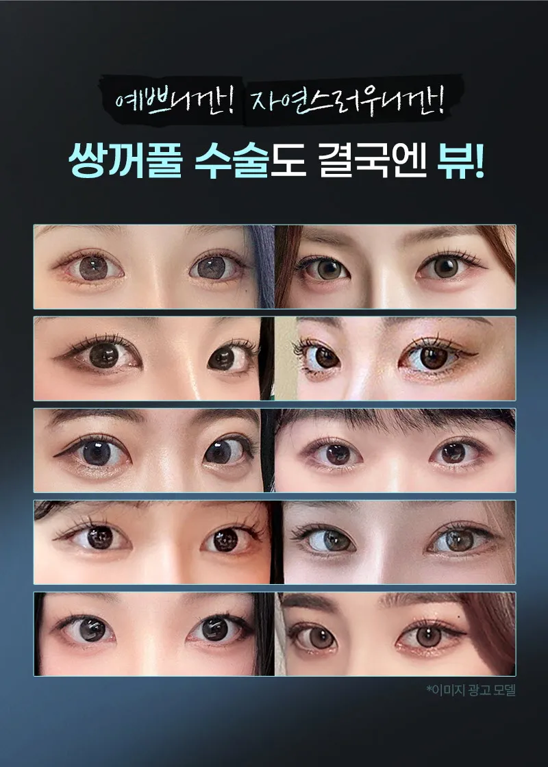 뷰성형외과 ❤️뷰❤️눈성형 이벤트, 시술 상세 이미지