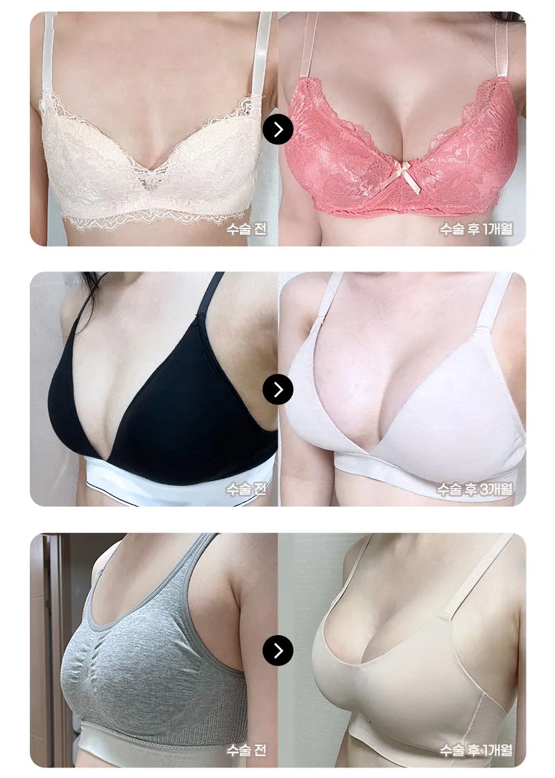 뷰성형외과 ❤️뷰❤️멘토 가슴성형 이벤트, 시술 상세 이미지