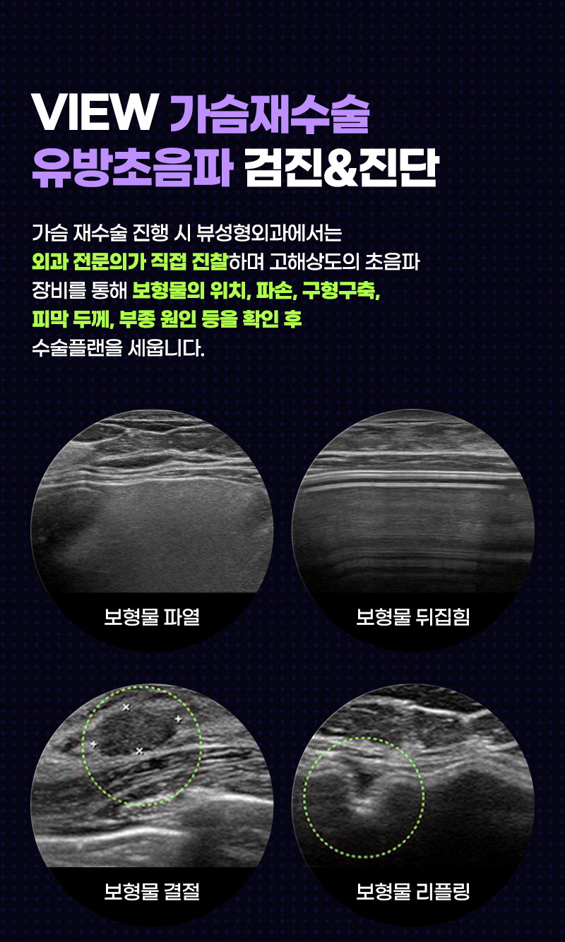 뷰성형외과 ❤뷰❤모티바 가슴 재수술 이벤트, 시술 상세 이미지