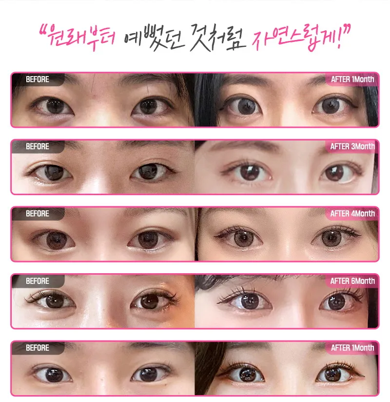 뷰성형외과 ❤️뷰❤️눈재수술 이벤트, 시술 상세 이미지
