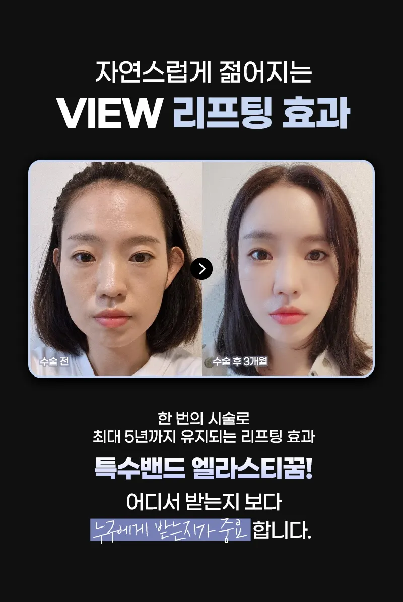 뷰성형외과 ❤뷰❤엘라스티꿈 실리프팅 이벤트, 시술 상세 이미지