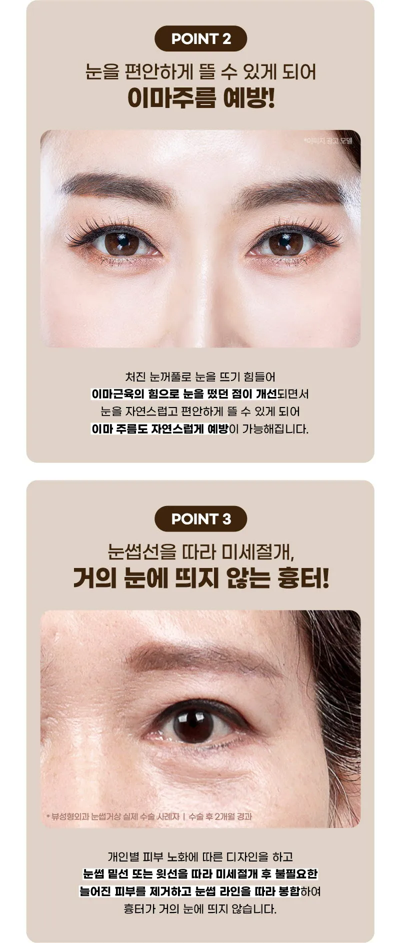 뷰성형외과 ❤️뷰❤️눈썹거상술 이벤트, 시술 상세 이미지