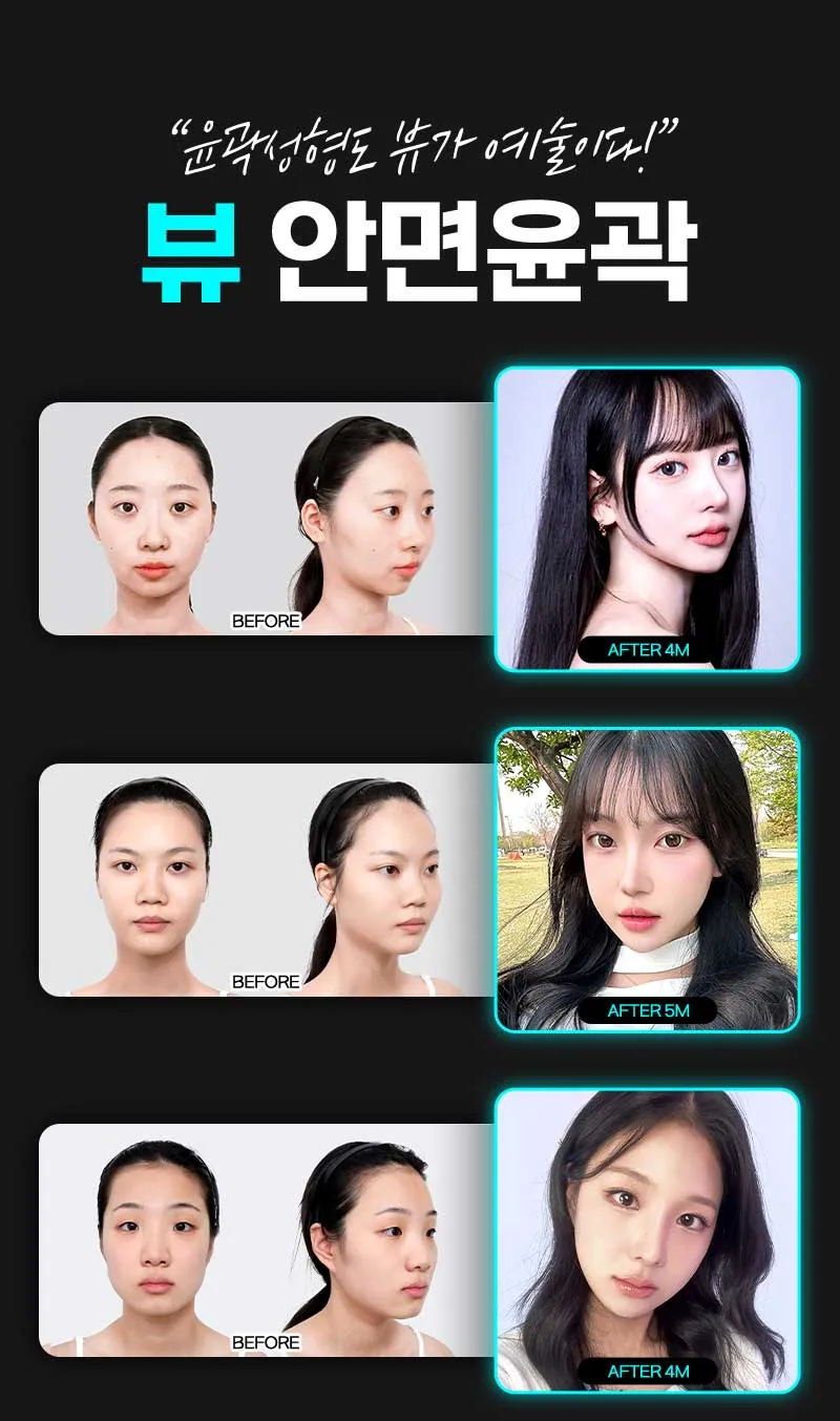 뷰성형외과 ❤️뷰❤️안면윤곽 이벤트, 시술 상세 이미지