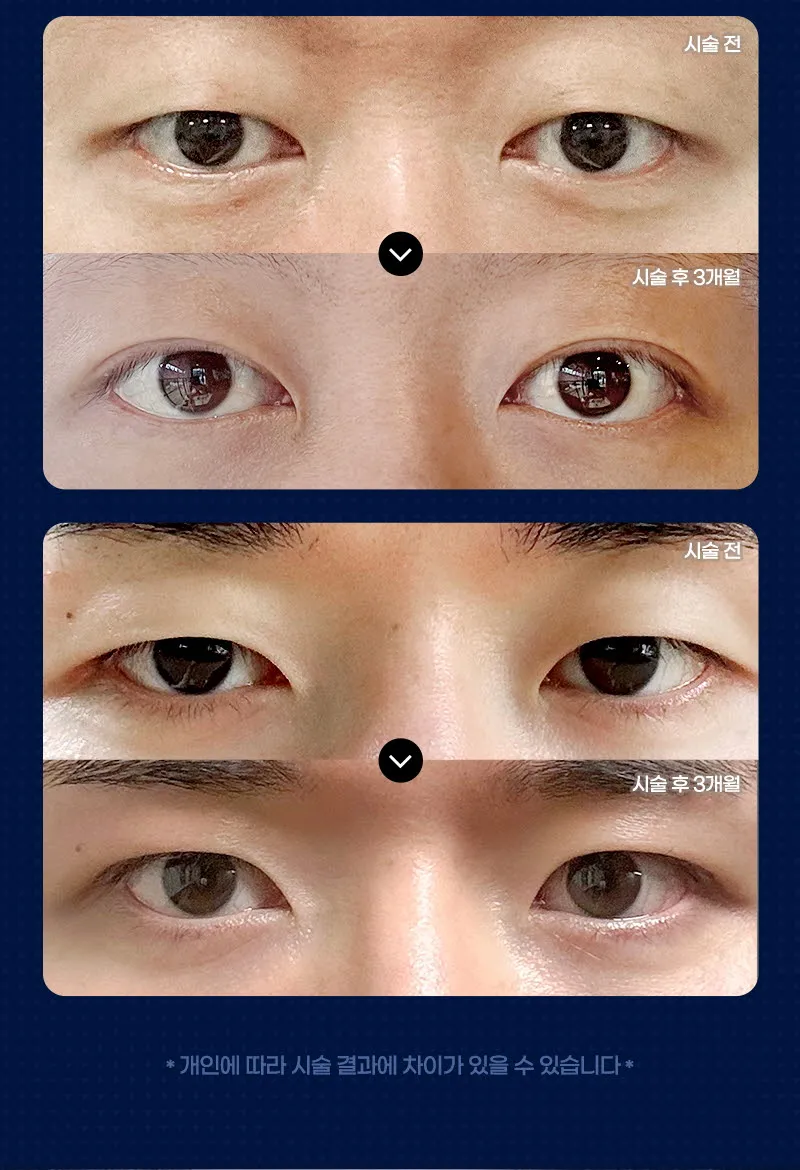 뷰성형외과 ❤️뷰❤️남자 눈성형 이벤트, 시술 상세 이미지