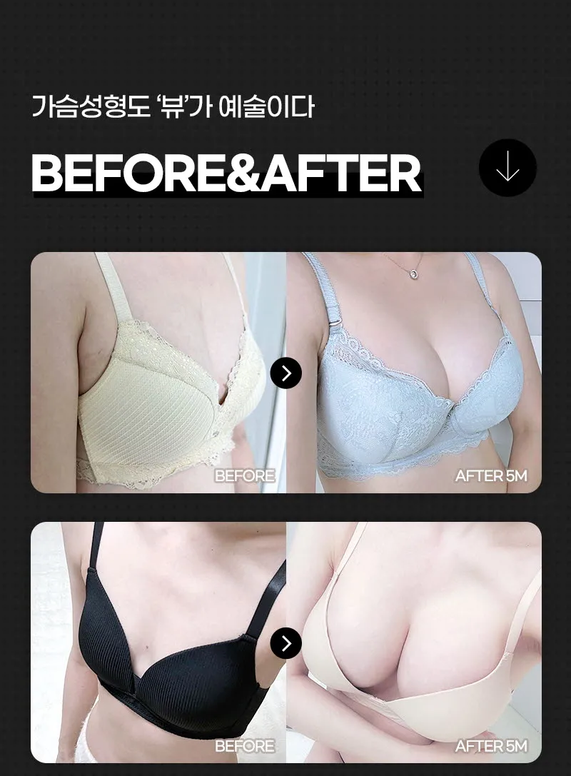 뷰성형외과 ❤️뷰❤️UIU 가슴성형 240 이벤트, 시술 상세 이미지