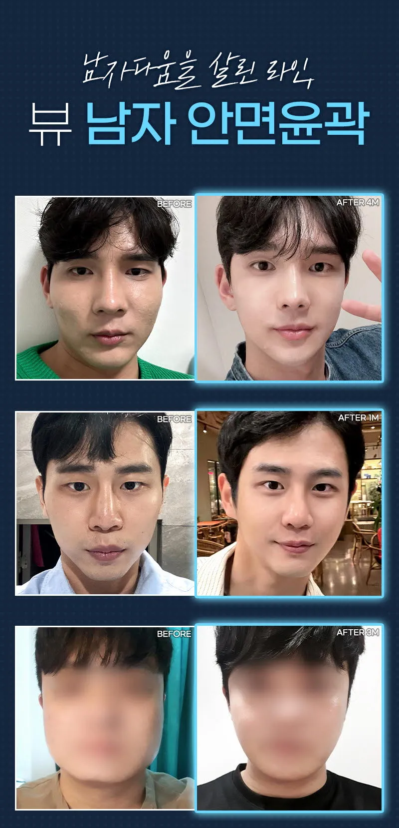 뷰성형외과 ❤️뷰❤️남자 안면윤곽 이벤트, 시술 상세 이미지