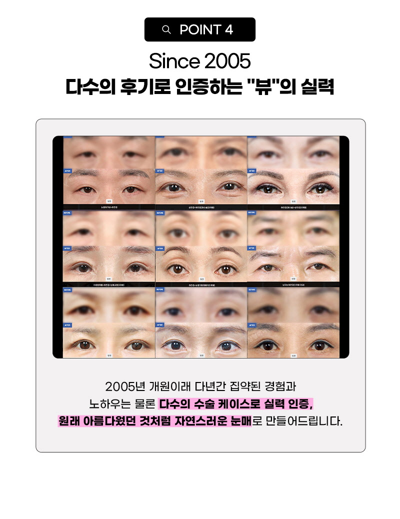 뷰성형외과 ❤️뷰❤️중년 눈성형 이벤트, 시술 상세 이미지