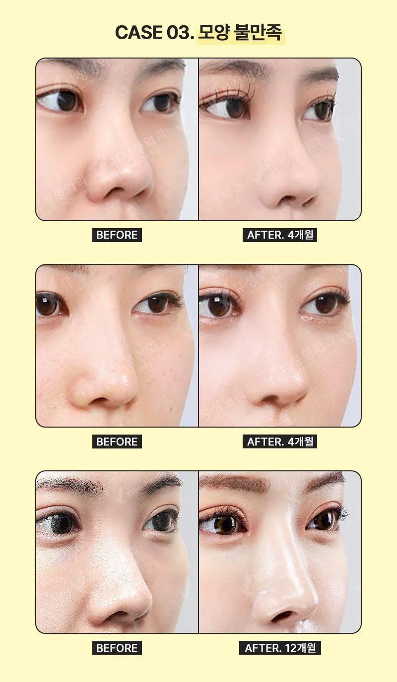 뷰성형외과 ❤️뷰❤️코재수술 이벤트, 시술 상세 이미지