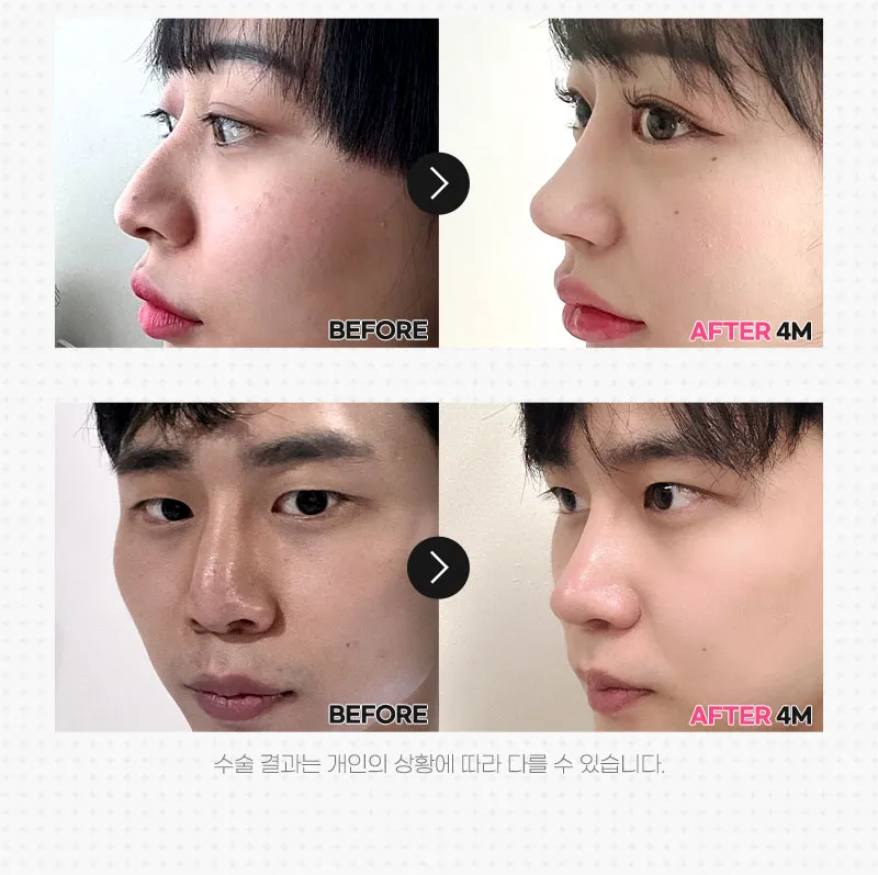 뷰성형외과 ❤️뷰❤️매부리코성형 이벤트, 시술 상세 이미지