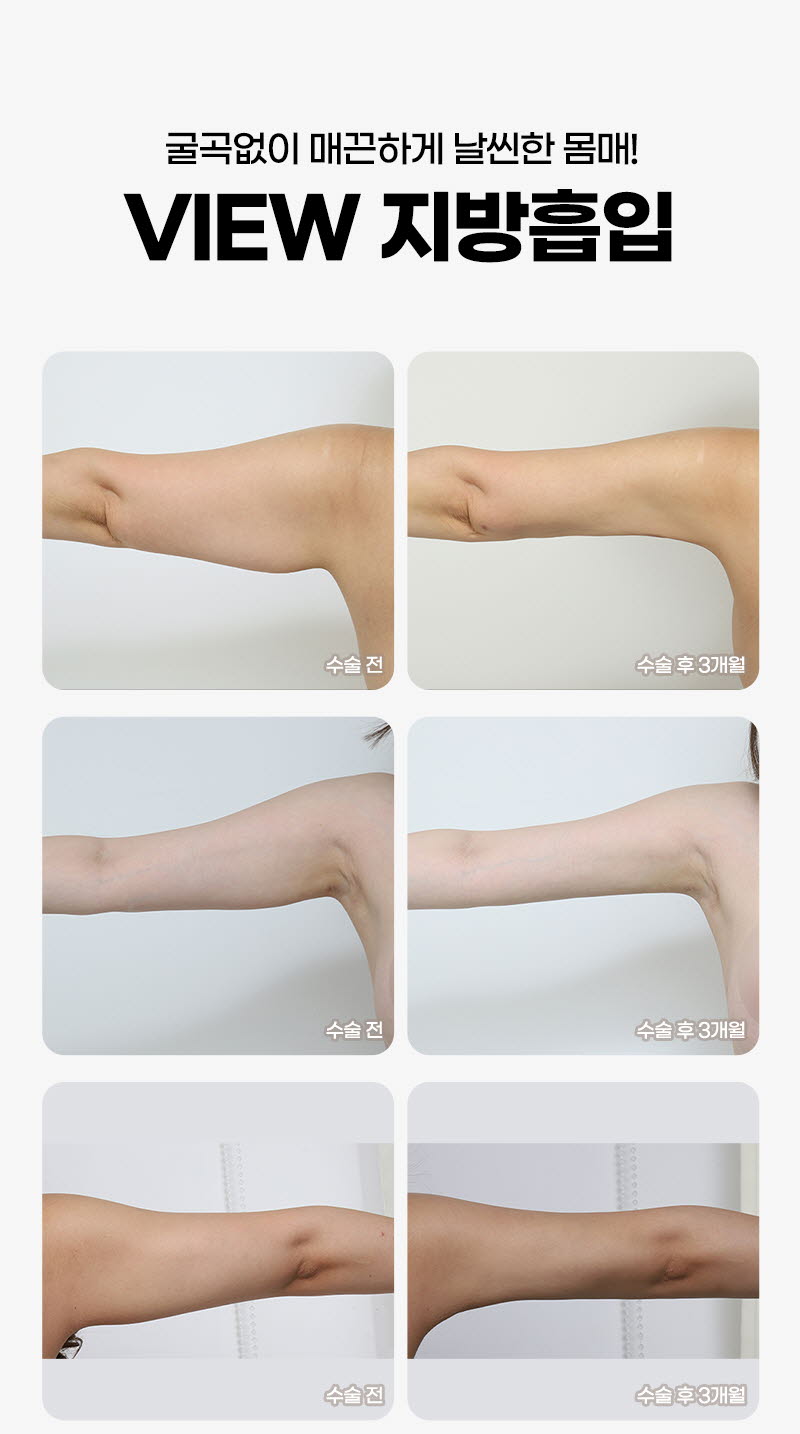 뷰성형외과 ❤️뷰❤️대용량 지방흡입 이벤트, 시술 상세 이미지