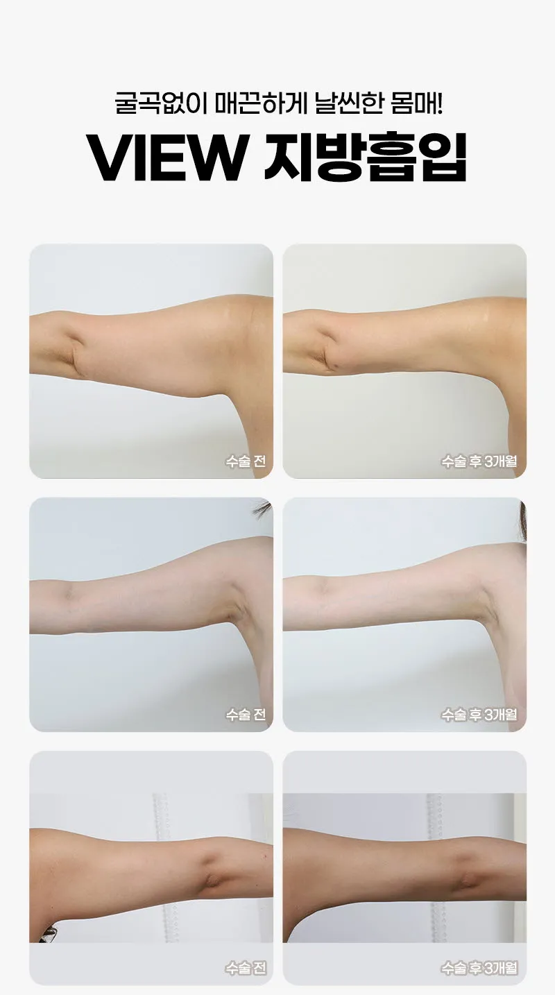 뷰성형외과 ❤️뷰❤️대용량 지방흡입 이벤트, 시술 상세 이미지