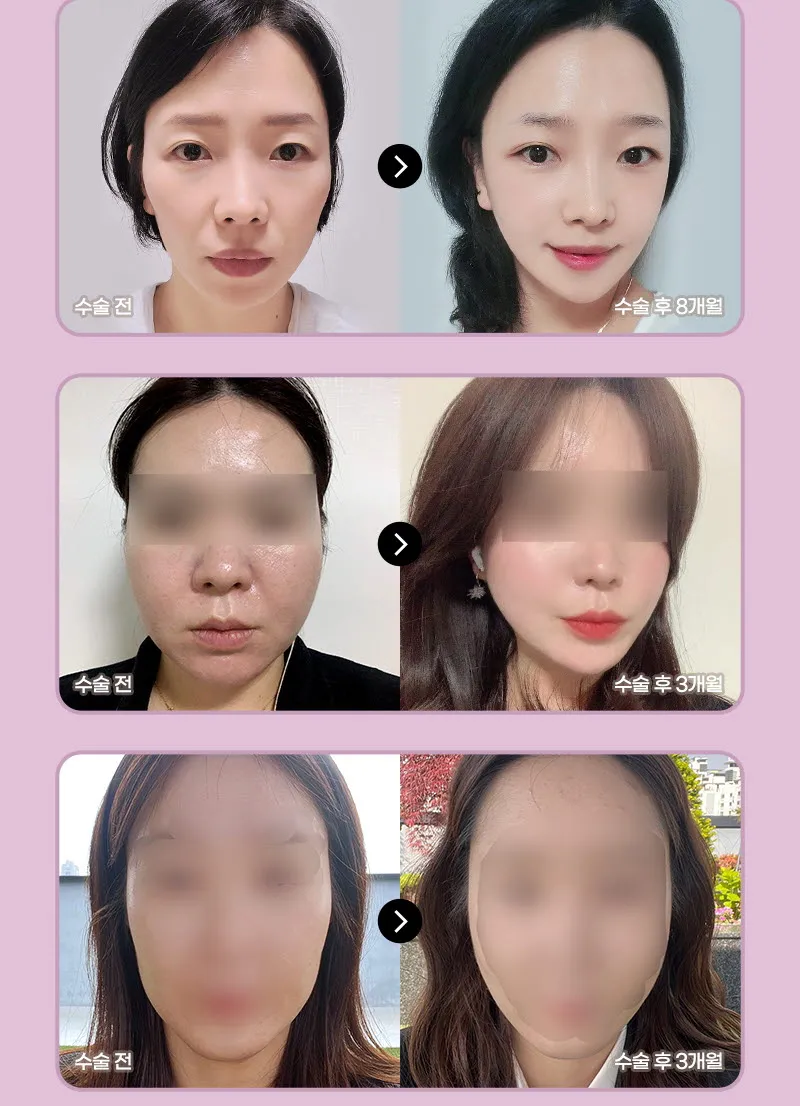 뷰성형외과 ❤뷰❤미니거상 이벤트, 시술 상세 이미지