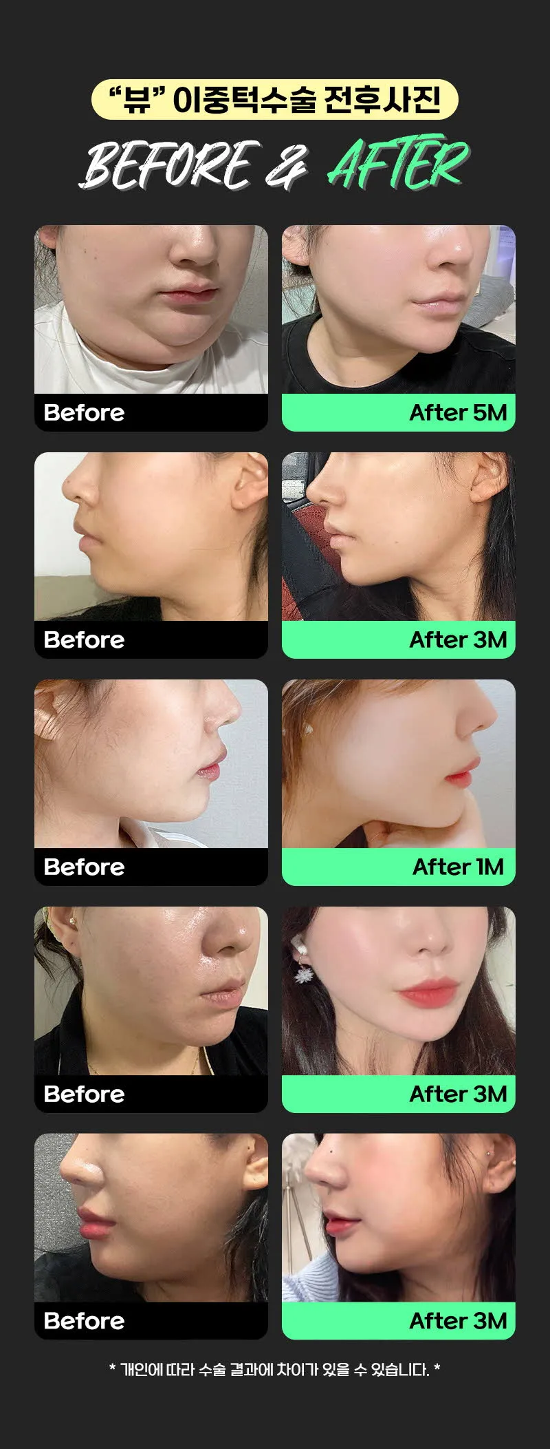 뷰성형외과 ❤뷰❤얼굴 지방흡입 이벤트, 시술 상세 이미지