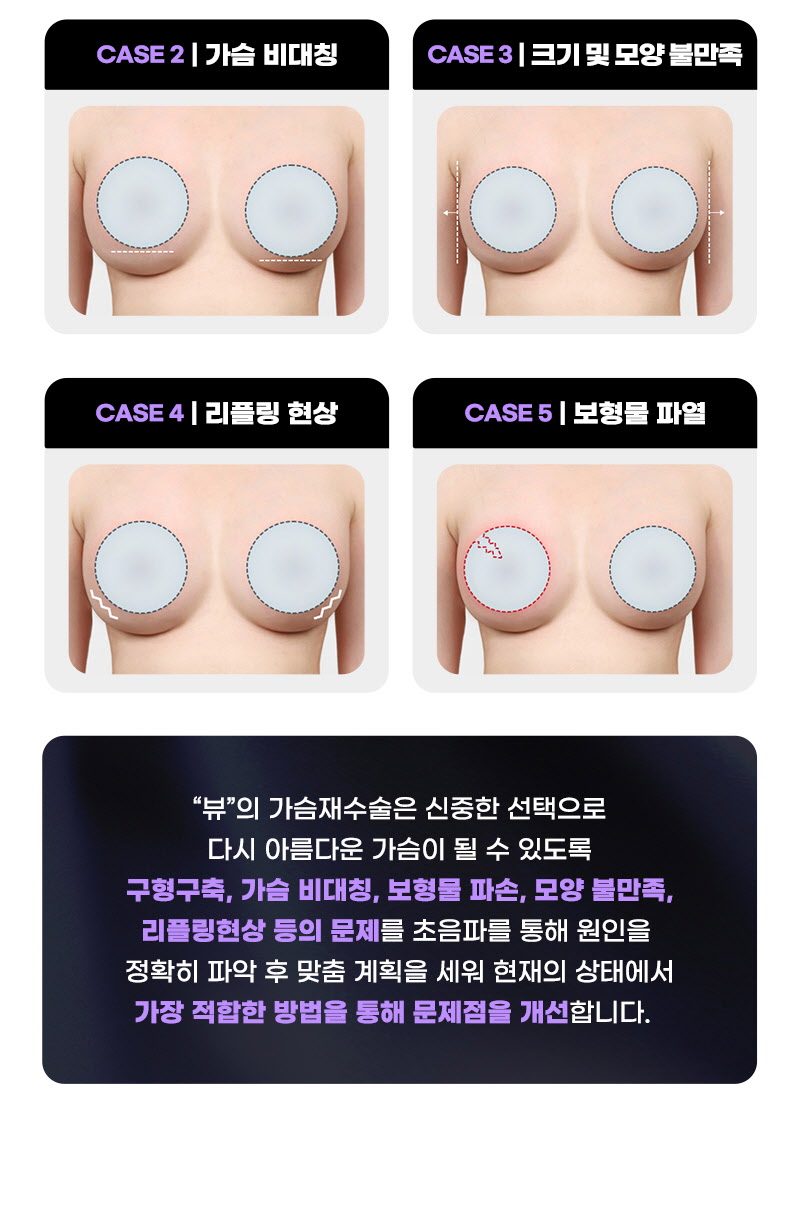 뷰성형외과 ❤뷰❤모티바 가슴 재수술 이벤트, 시술 상세 이미지